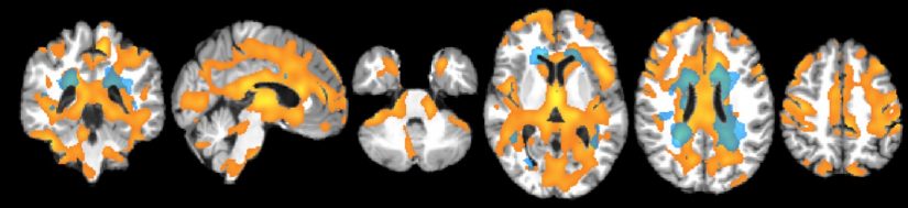 Maladies neurodégénératives et vieillissement, une question de fonds 1