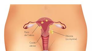 Chirurgie sans cicatrice en passant par les orifices naturels 1