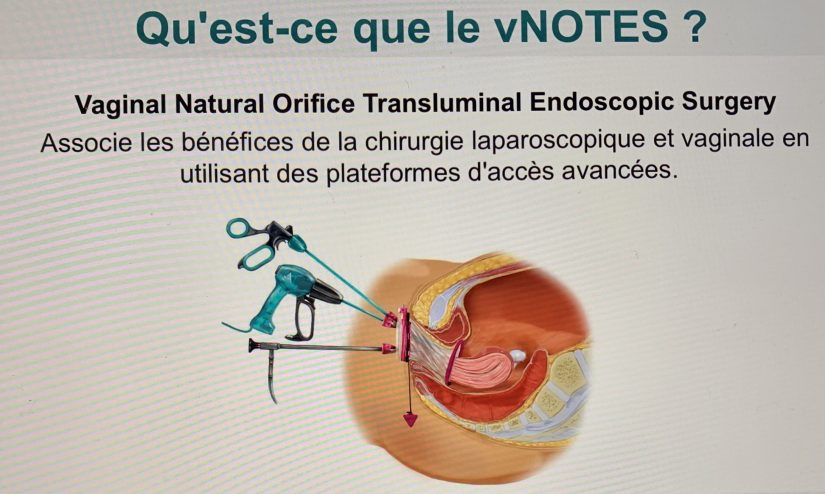 Chirurgie sans cicatrice en passant par les orifices naturels 5