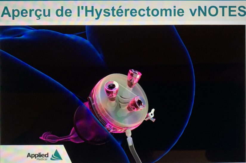 Chirurgie sans cicatrice en passant par les orifices naturels 6