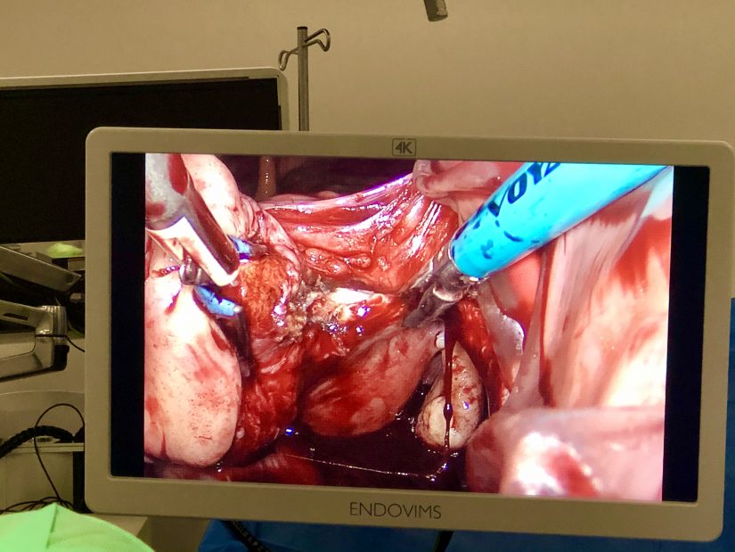 chirurgie-orifices-uterus-technique-innovante