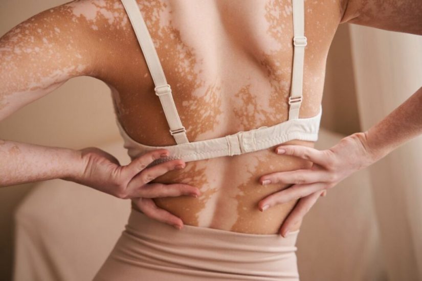 Accepter et afficher son vitiligo, cette maladie de peau trop visible 1