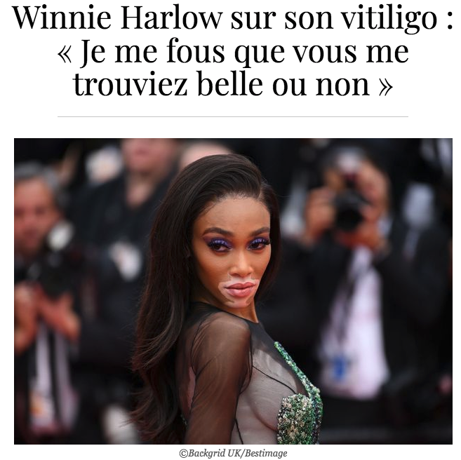 Accepter et afficher son vitiligo, cette maladie de peau trop visible 2
