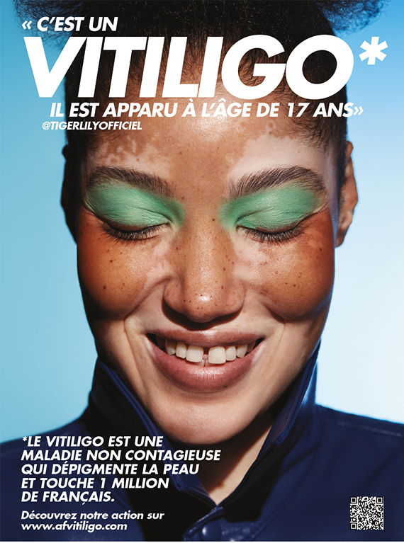 Accepter et afficher son vitiligo, cette maladie de peau trop visible 3